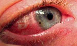 Воспаление глаз