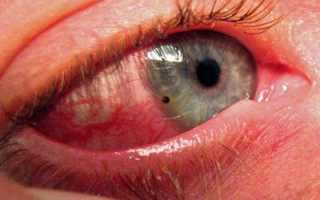 Воспаление глаз