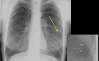 Глисты в легких: симптомы и лечение