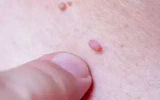 Вирус папилломы человека