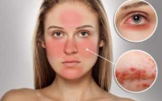 Лучшие средства для лечения демодекоза в домашних условиях