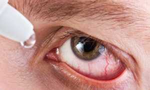 Лечение халязиона с помощью капель