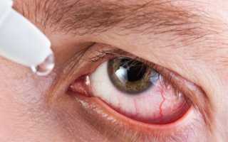 Лечение халязиона с помощью капель