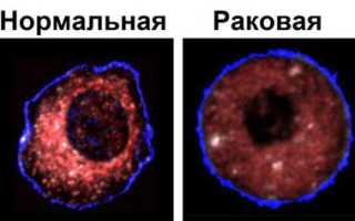Интоксикация организма при онкологии
