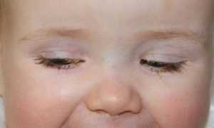 Детский аденовирусный конъюнктивит, особенности лечения