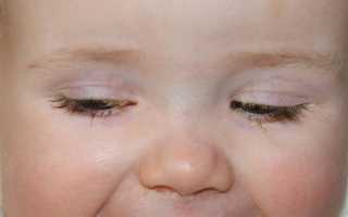 Детский аденовирусный конъюнктивит, особенности лечения