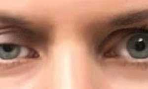 Особенности косоглазия и его виды