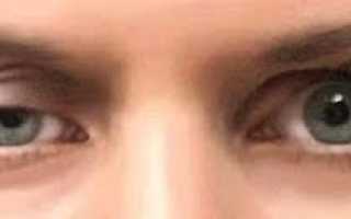 Особенности косоглазия и его виды