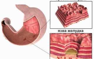 Режущая боль в желудке