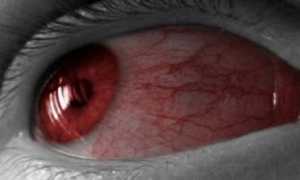 Покраснение белков глаз: причины и лечение