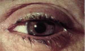 Лечение демодекоза с помощью гелей