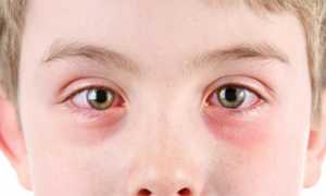 Покраснение глаз у детей: причины и лечение недуга