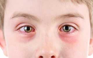 Покраснение глаз у детей: причины и лечение недуга