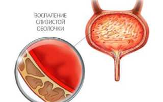 Чем опасно употребление рыбы, зараженной солитером?