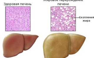 Острая жировая дистрофия печени при алкогольной интоксикации