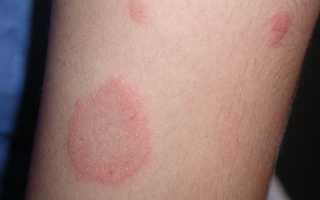 Виды грибковых заболеваний