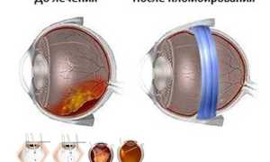Операция для исправления разрыва сетчатки
