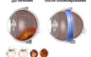 Операция для исправления разрыва сетчатки