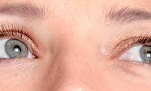 Бельмо на глазу: причины, диагностика и лечение