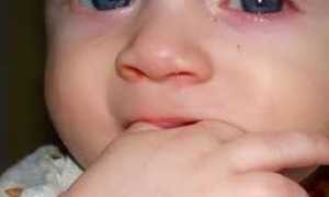 Народная медицина в лечении конъюнктивита у детей