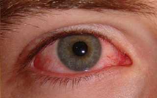 Диагностика глаукомы, особенности заболевания и лечения