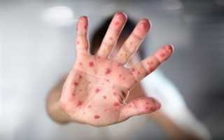 Нужна ли прививка от краснухи