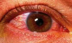 Симптомы отека зрительного нерва