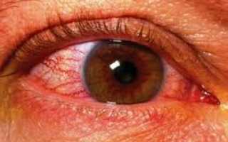 Симптомы отека зрительного нерва