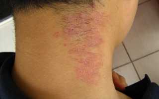 Сыпь при лямблиозе у ребёнка: виды, лечение и фото