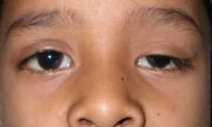 Признаки скрытого косоглазия