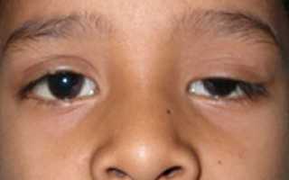 Признаки скрытого косоглазия