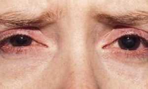 Народные методы для лечения блефарита