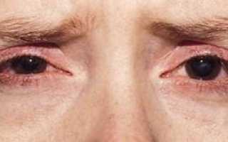 Народные методы для лечения блефарита