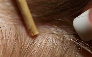 Как избавиться от гнид в домашних условиях