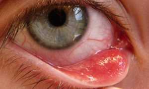 Грибковый кератит: особенности заболевания