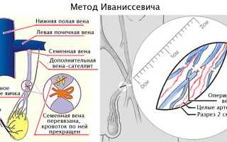 Операция Мармара при варикоцеле