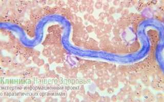 Микрофилярии в крови у человека — Дирофиляриоз