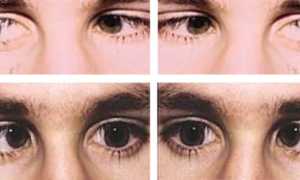 Нистагм: виды, симптомы и особенности лечения