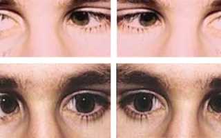 Нистагм: виды, симптомы и особенности лечения