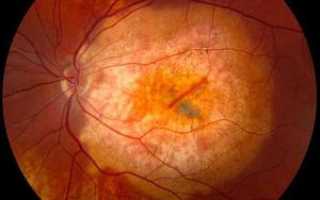 Что такое ретинопатия?