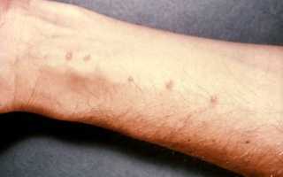 Что такое шистосомы: симптомы и лечение