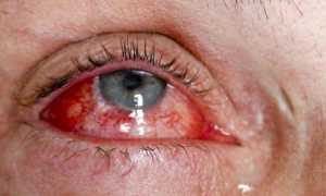 Причина возникновения хламидийного конъюнктивита