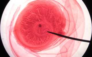 Цистицеркоз головного мозга, глаз, кожи, мышц