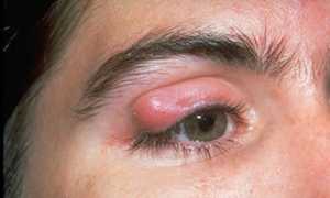 Халязион верхнего века, диагностика и лечение образования