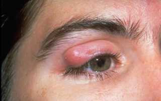 Халязион верхнего века, диагностика и лечение образования