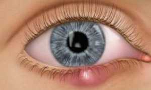 Медикаментозное лечение ячменя, профилактика болезни