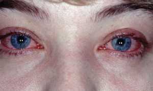 Опасен ли конъюнктивит во время беременности? Особенности лечения