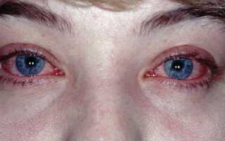 Опасен ли конъюнктивит во время беременности? Особенности лечения