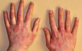 На сколько повышаются эозинофилы при гельминтах