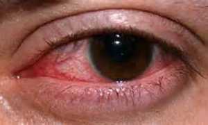 Особенность аллергического конъюнктивита и тонкости лечения